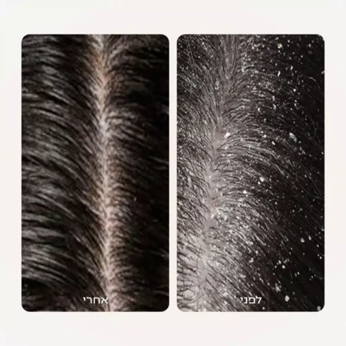 Alternative view of שמפו טיפולי לקשקשים והרגעת קרקפת רגישה | Kamedis SCALP CONTROL